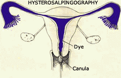 Hysterosalpingography