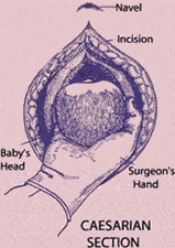 Cesarean Section