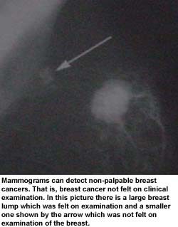 non palpable breast cancer Non palpable breast cancer