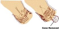 Cone Biopsy